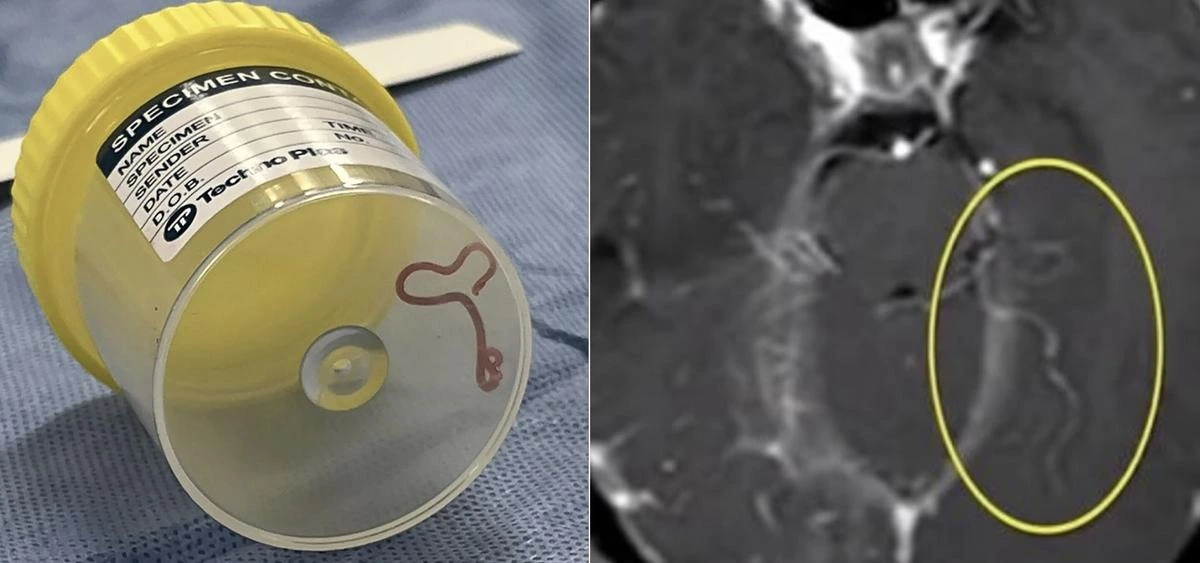 Parasitic Worm 3 inch long Discovered in Woman's Brain